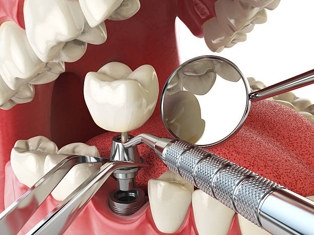 Best Emergency Tooth Extraction in Bear, DE